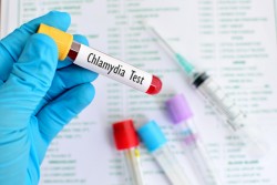 Dépistage de la Chlamydia systématique conseillé pour les femmes de 15 à 25 ans 